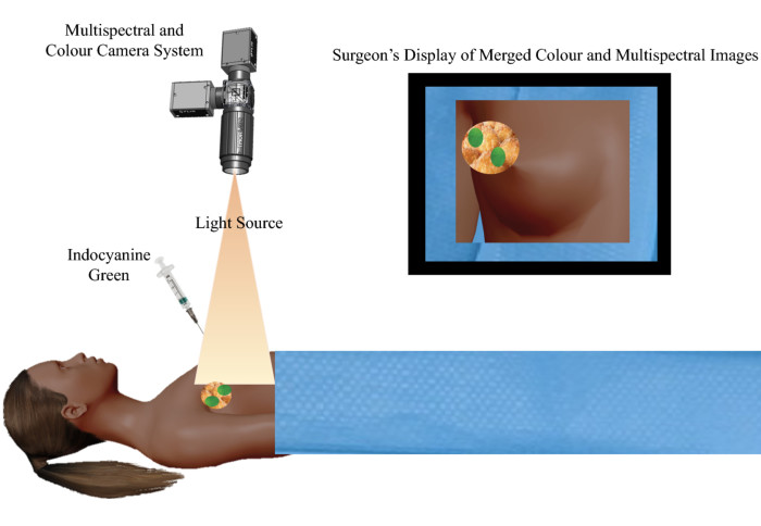 Indocyanine Green fluorescence imaging for tumor visualization in early cancer detection."
